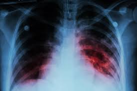 En Hidalgo, 204 casos de tuberculosis: SSH