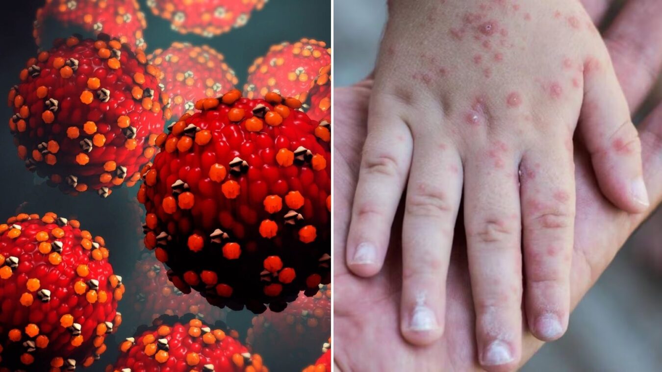 Salud confirma 74 casos activos de sarampión en México.