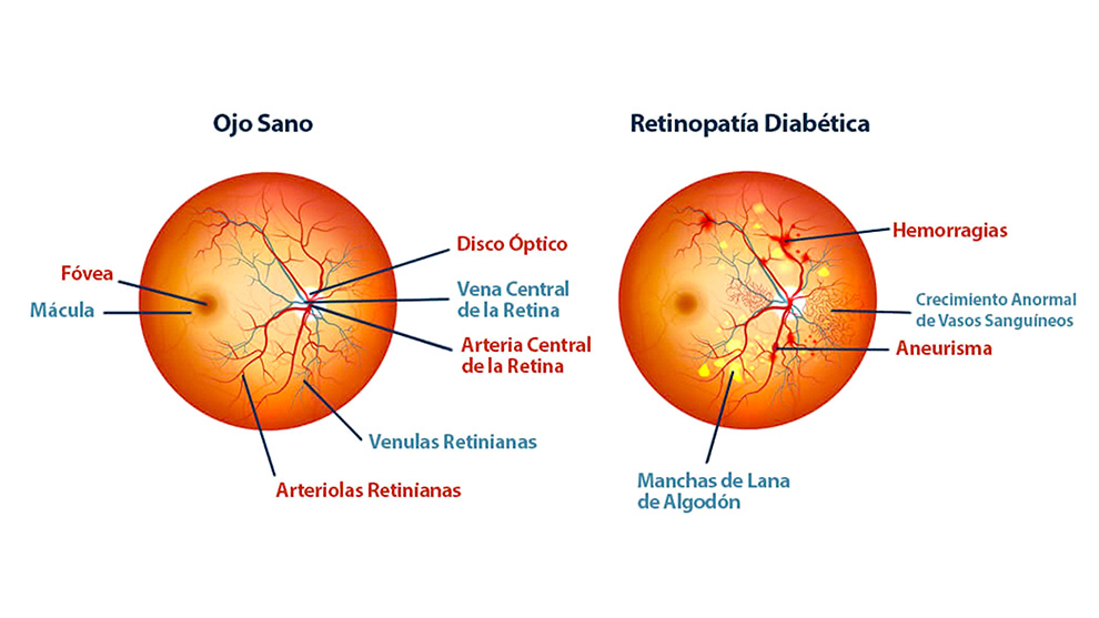 Gotas oftálmicas contra la ceguera por diabetes